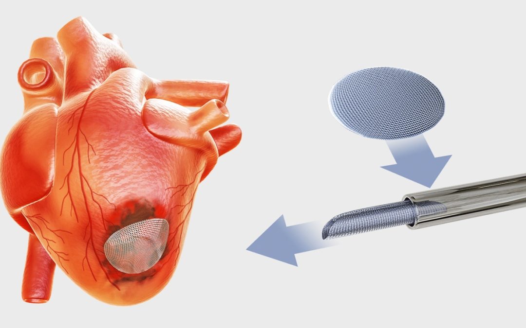 Freethink: New cardiac patch can be implanted with a syringe