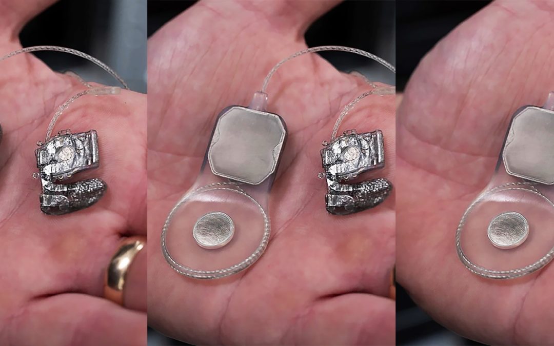 Experimental bionic eye is ready for human trials